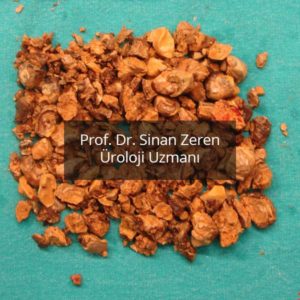 Böbrek Taşı 4 - Prof. Dr. Sinan Zeren
