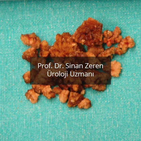 Böbrek Taşı 3 - Prof. Dr. Sinan Zeren