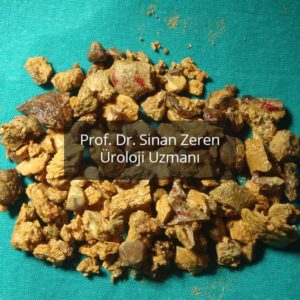 Böbrek Taşı 5 - Prof. Dr. Sinan Zeren