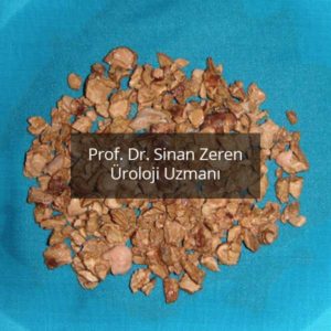 Böbrek Taşı 2 - Prof. Dr. Sinan Zeren