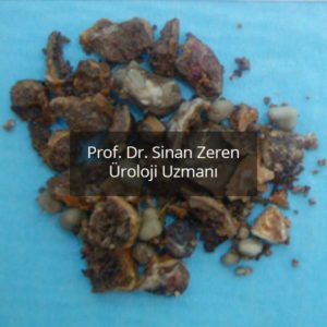 Böbrek Taşı 1 - Prof. Dr. Sinan Zeren