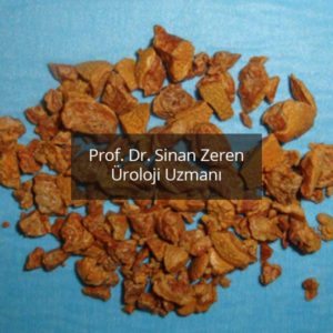 Böbrek Taşı 6 - Prof. Dr. Sinan Zeren