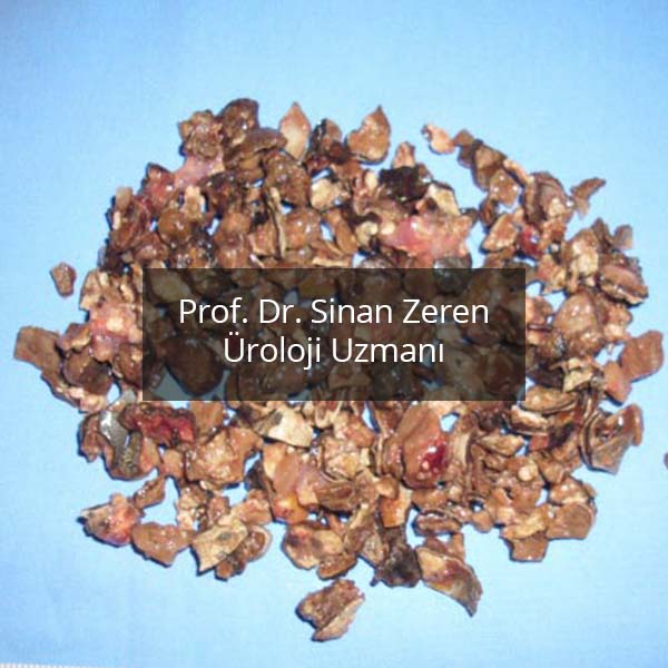 Böbrek Taşı 7 - Prof. Dr. Sinan Zeren