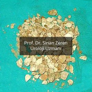 Böbrek Taşı 8 - Prof. Dr. Sinan Zeren