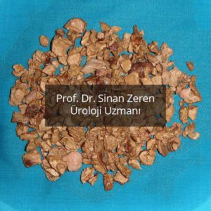 Böbrek Taşı 8 - Prof. Dr. Sinan Zeren